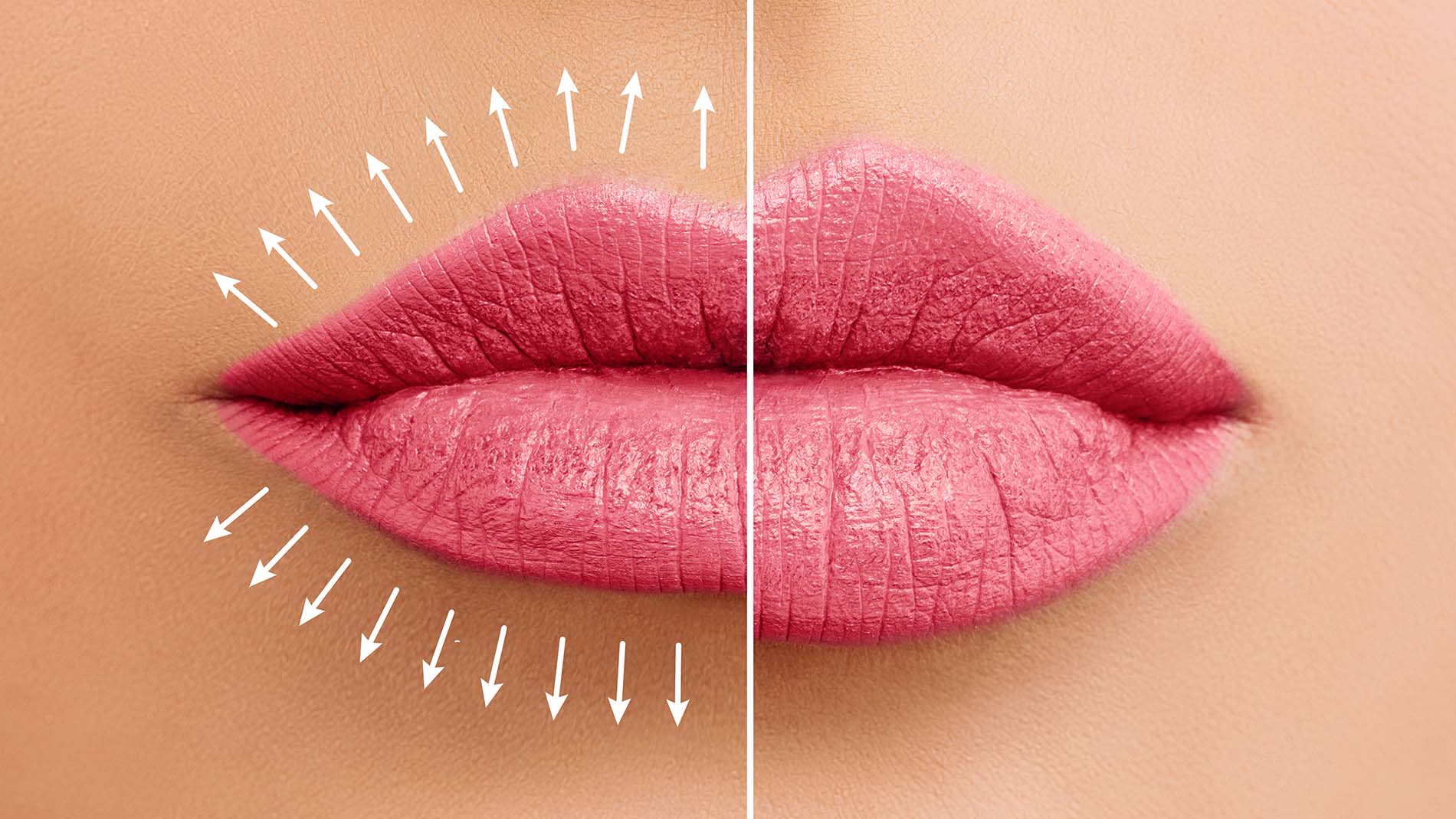 Lippenunterspritzung – Methoden und Techniken