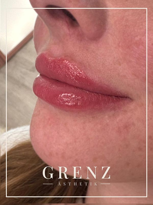 Butterfly-Lips – Lippenunterspritzung