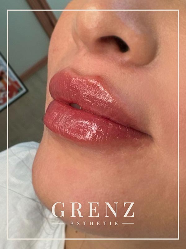 Doll Lips – Lippenunterspritzung