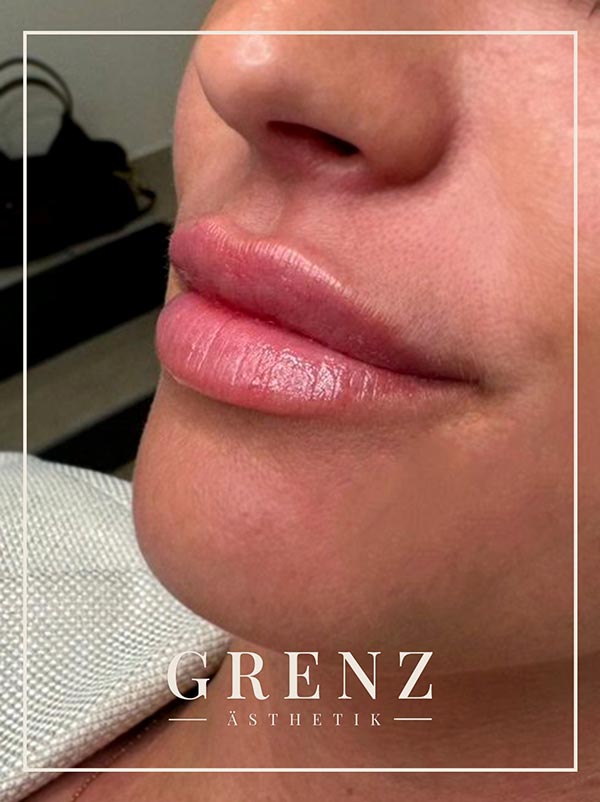 Natural Russian Lips – Lippenunterspritzung